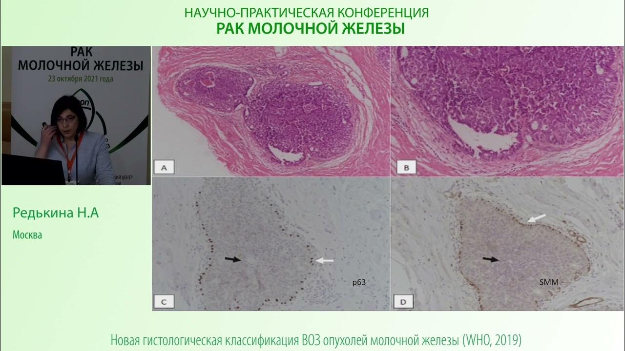 раскин григорий александрович онколог. метапластический рак молочной. плоскоклеточная карцинома g3. плоскоклеточные клетки. апокриновая карцинома молочной железы.