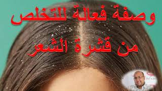 وصفة فعالة للتخلص من قشرة الشعر دكتور عماد ميزاب