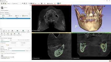 STL models from CT scan