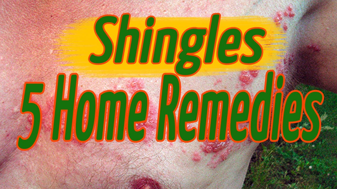 Shingles Home Remedies 5 Effective Methods by How To Remove Herpes