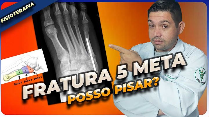 FRATURA do 5 Metatarso TEMPO DE RECUPERAÇÃO e QUANDO PISAR