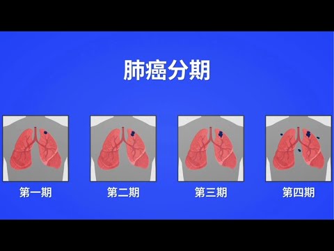 为什么肺癌分期很重要？