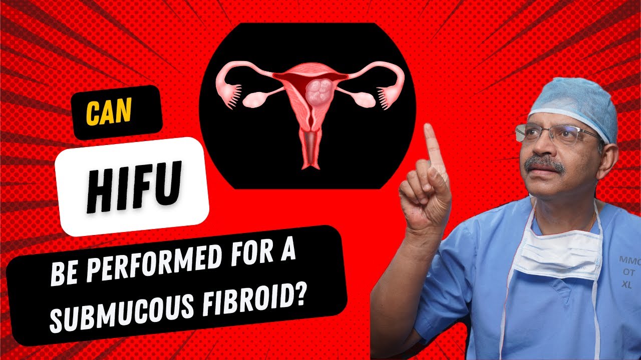 Можно ли использовать HIFU для уменьшения подслизистой миомы?
