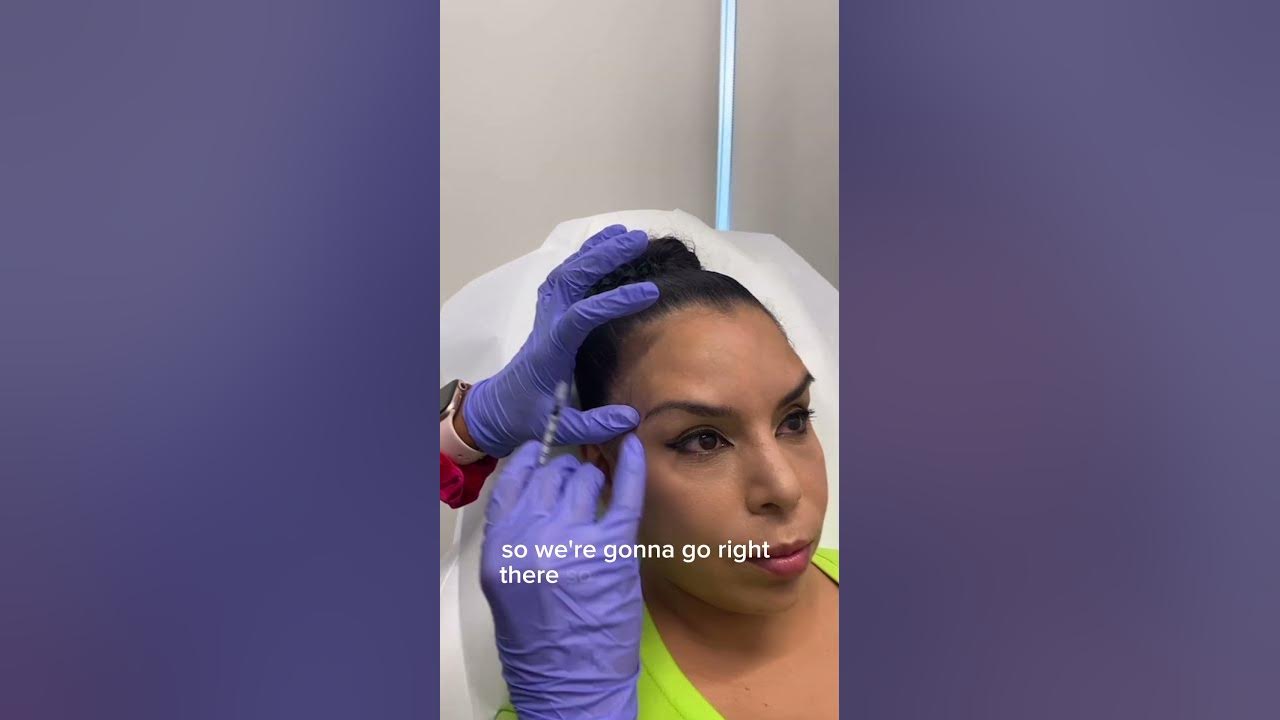 spock-brow-from-botox-easy-fix-youtube