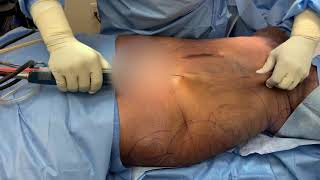 Brazilian Butt Lift- Dr. Michael Jones I Lexington Plastic Surgeons