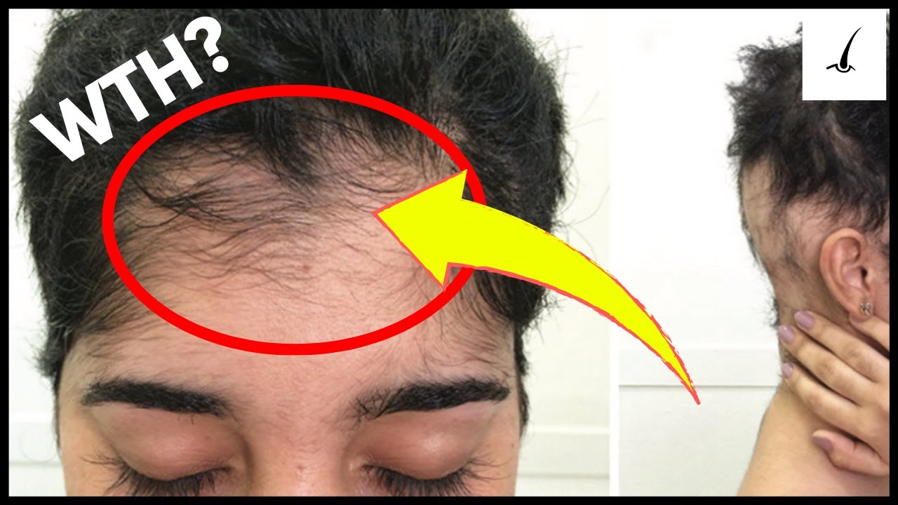 Minoxidil Side Effects MUST WATCH Before Starting YouTube