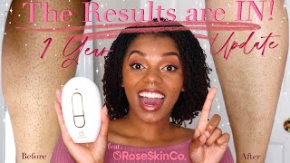 The Results are IN! At home laser hair removal 1 Yr. Update feat. RoseSkinCo Lumi || IPL Journey