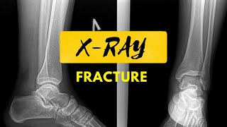 Fracture | Things Found In An Xray | Radiological Survey Images