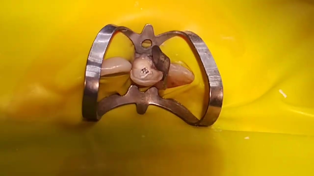 Single isolation 21 tooth.