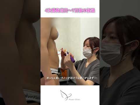 授乳後の脂肪豊胸4回目に密着！