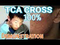 How To Use TCA CROSS 100% Demonstration | Self Treatment at home for Acne Scars Removal