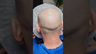 Scalp Micropigmentation In Kent, SMP, Scalp Tattoo, Hair Tattoo, Men's Hair Loss Solution In Kent.