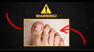 ONLY Cure for Toenail Fungus From Home - How To Cure Toenail Fungus