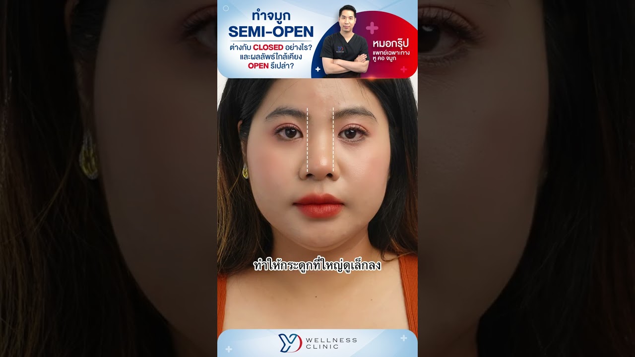 ทำจมูก Semi open ต่างกับ Closed อย่างไร? | By หมอกรุ๊ป
