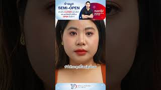 ทำจมูก Semi open ต่างกับ Closed อย่างไร? | By หมอกรุ๊ป