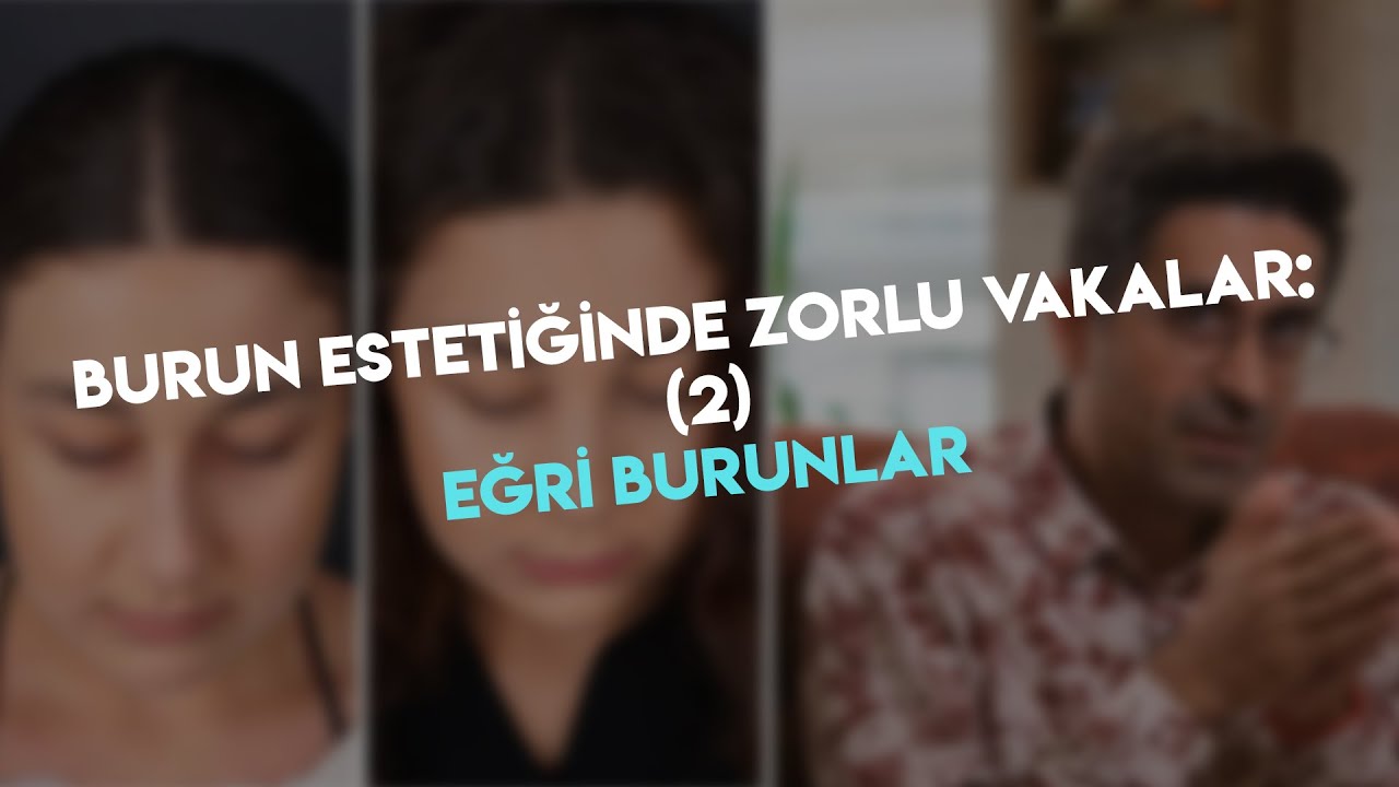Burun Estetiğinde Zorlu Vakalar: (2) Eğri Burunlar