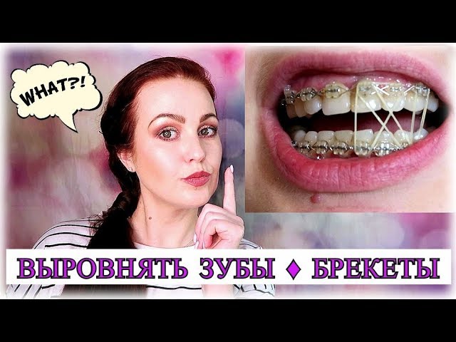 БРЕКЕТЫ ♦ Моя история ♦ Очередные ужасы и радости ♦Исправляю неудачное лечение ♥MamavPudre