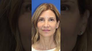 UNDETECTABLE Facelift at 65 - Before & After Her Vertical Restore Profile