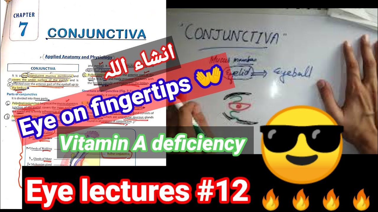 Eye lectures #12. #Pinguecula #Xerophthalmia#vitamins vitamin A