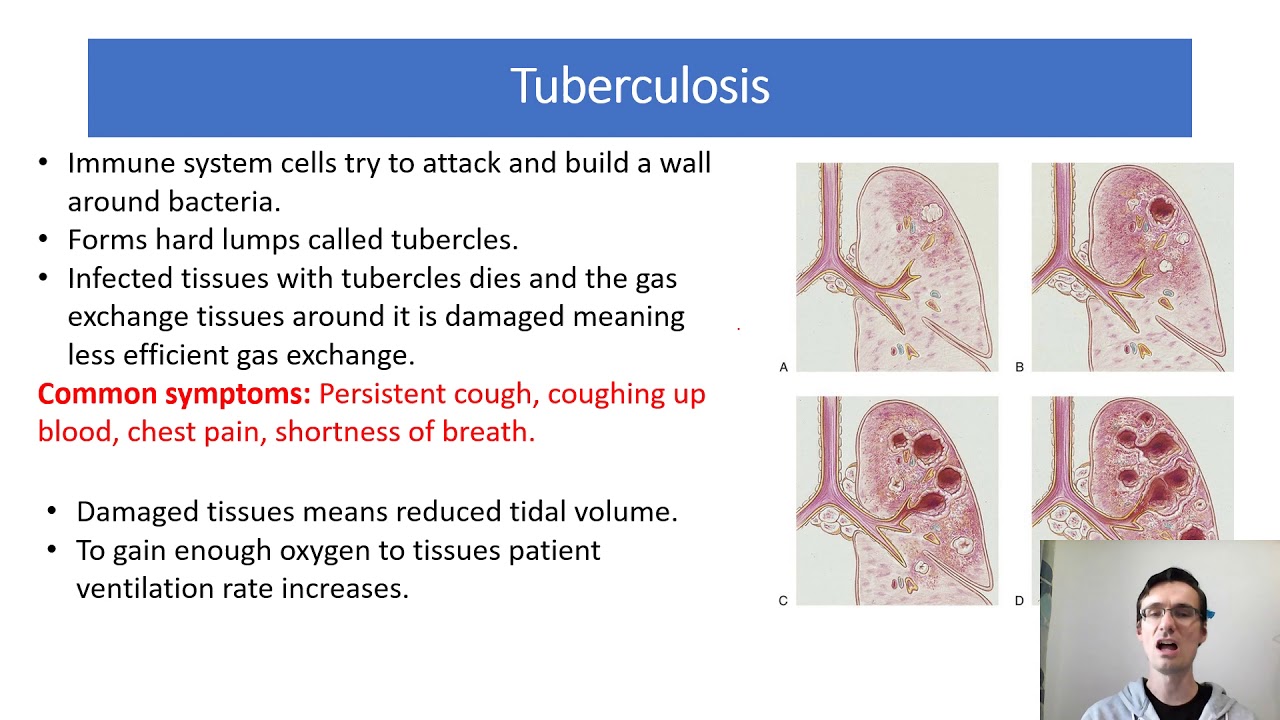 Tb Level Tuberculosis A Level