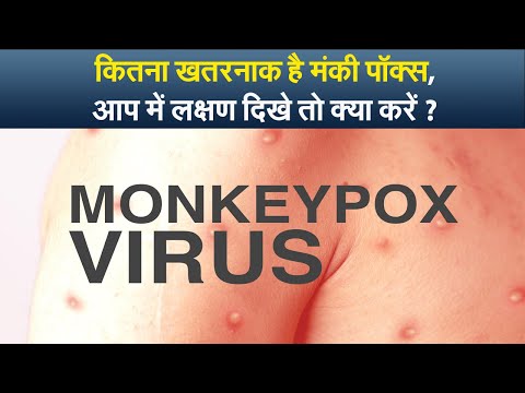 कितना खतरनाक है मंकी पॉक्स(monkeypox), आप में लक्षण (monkeypox symptoms) दिखे तो क्या करें ?