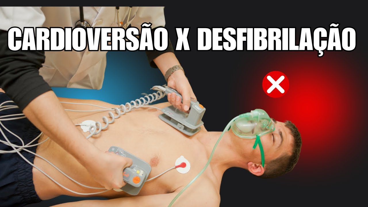 Cardioversão Elétrica Sincronizada ou Desfibrilação ? Como tratar uma ...