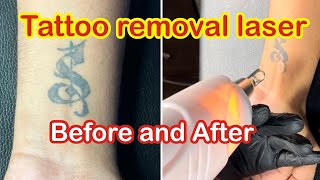 Tattoo removal laser before and after ( first treatment ) #tattooremoval screenshot 3