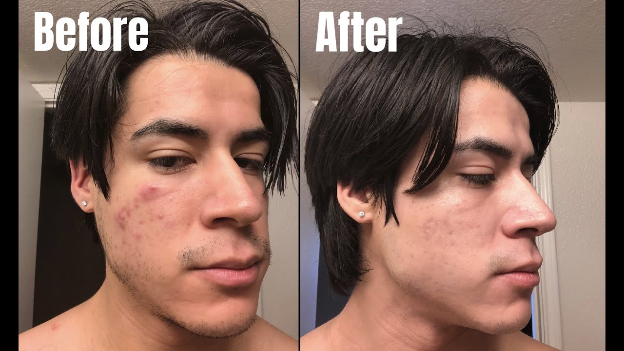 How I CLEARED MY ACNE and SCARRING in 3 months with AFFORDABLE skincare ...