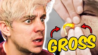 Reacting to the Grossest Pimple Popping Videos