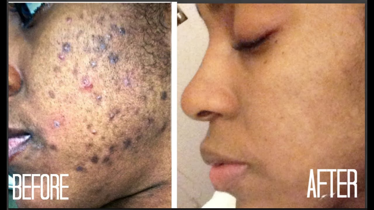 SKIN| How I Got Rid of Dark Scars (Hyperpigmentation 