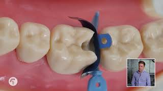 How To: Marginal Ridge Heights in Class II Restorations | Tips From Dr Lincoln Harris