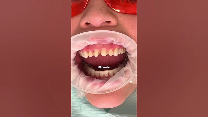 Composite vs porcelain veneers | which is best for you? | Dr. Yazdan | veneers before and after