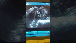 اورام ليفيه متعدده بالرحم. Multiple Uterine Fibroid