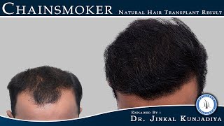 The Chainsmokers || Natural Hair Transplant Result || Best Hair Transplant Clinic In India