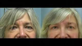 Fireside Chats with Dr. Edwin Williams Anesthesia for Blepharoplasty