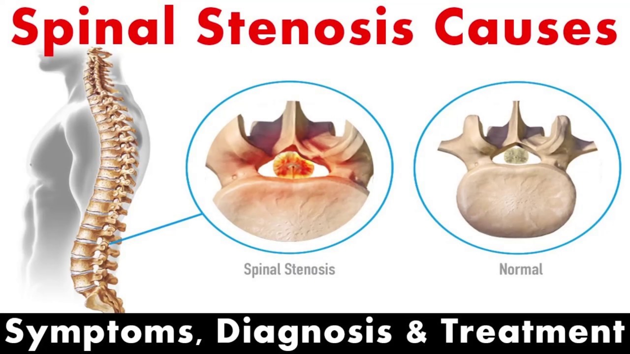 What is spinal stenosis what causes spinal stenosis what is the