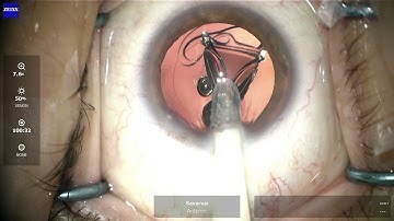 RayOne Hydrophobic IOL implantation - Dr Claudio Savaresi