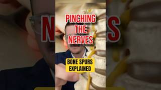 What are bone spurs (Spine Surgeon Explains) Spinal Bone Spurs