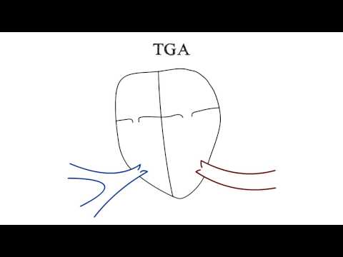 Transposition of the Great Arteries (TGA)