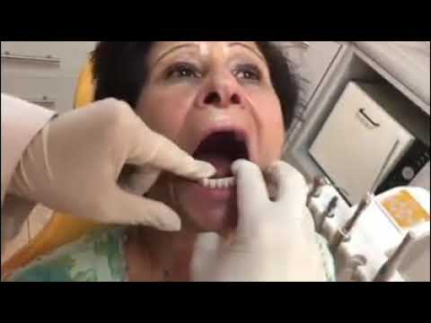 فيديو: 4 طرق للحفاظ على أطقم الأسنان السفلية في مكانها