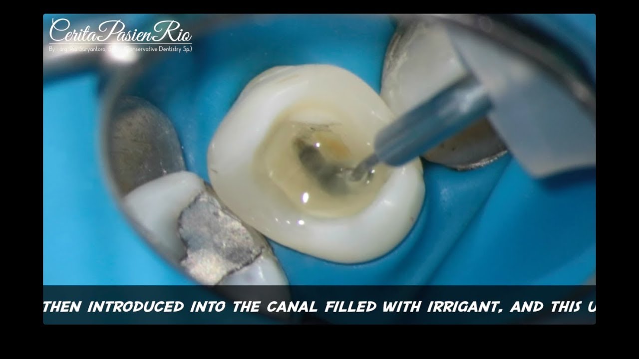 Passive ultrasonic irrigation (PUI) activation endodontic with ultraX