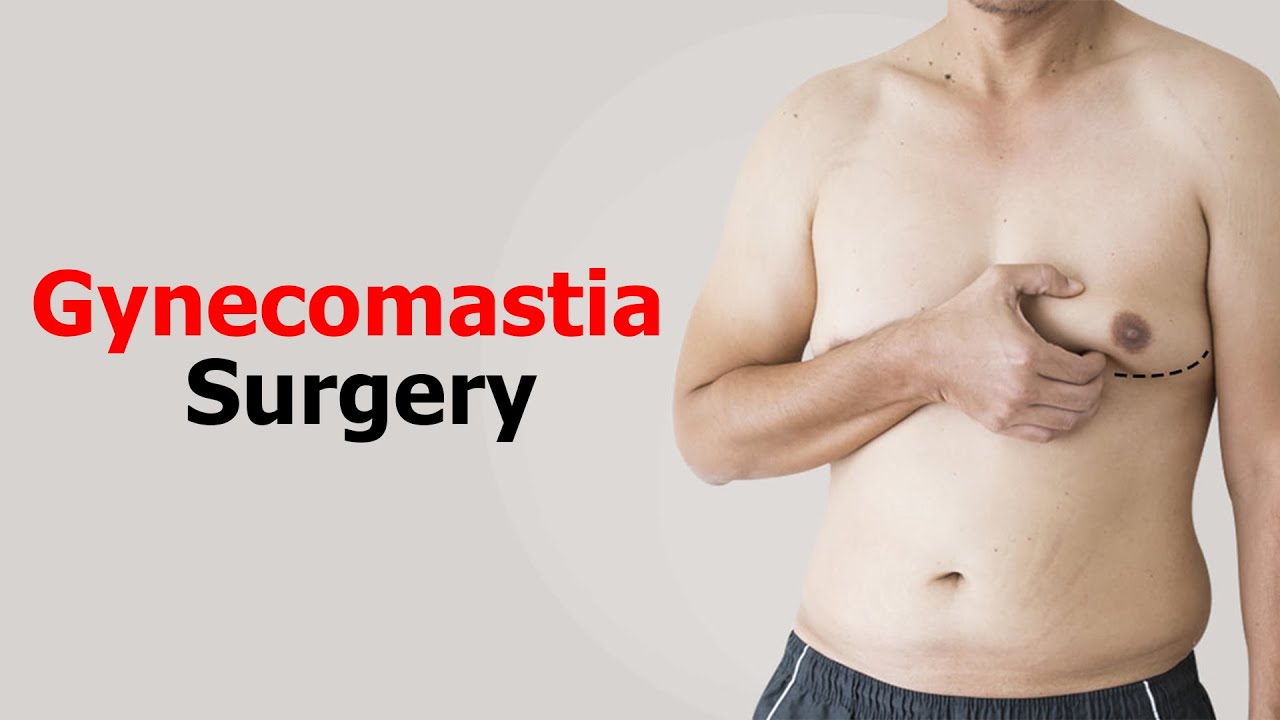 Gynecomastia Gland Removal Surgery | Vaser Lipo | Male Chest Reshaping | Dr Prashant Yadav | India |