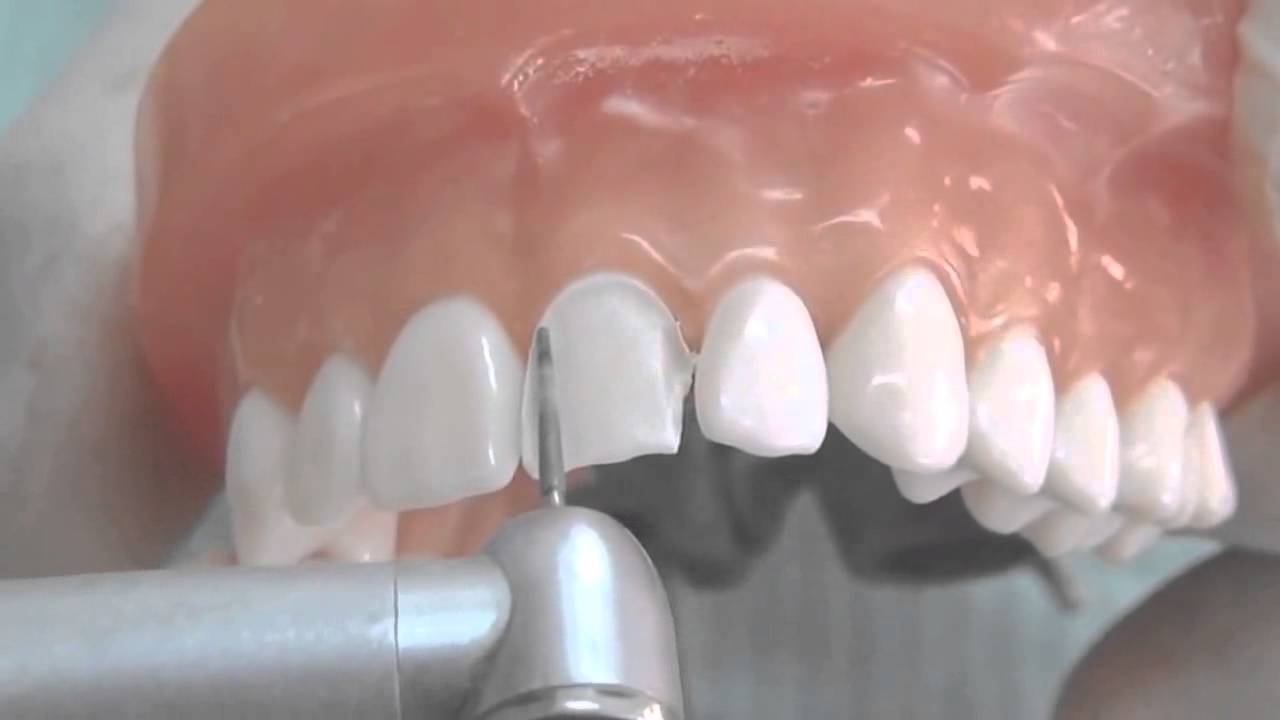 All Ceramic Crown Tooth Preparation [for Dental Students] YouTube