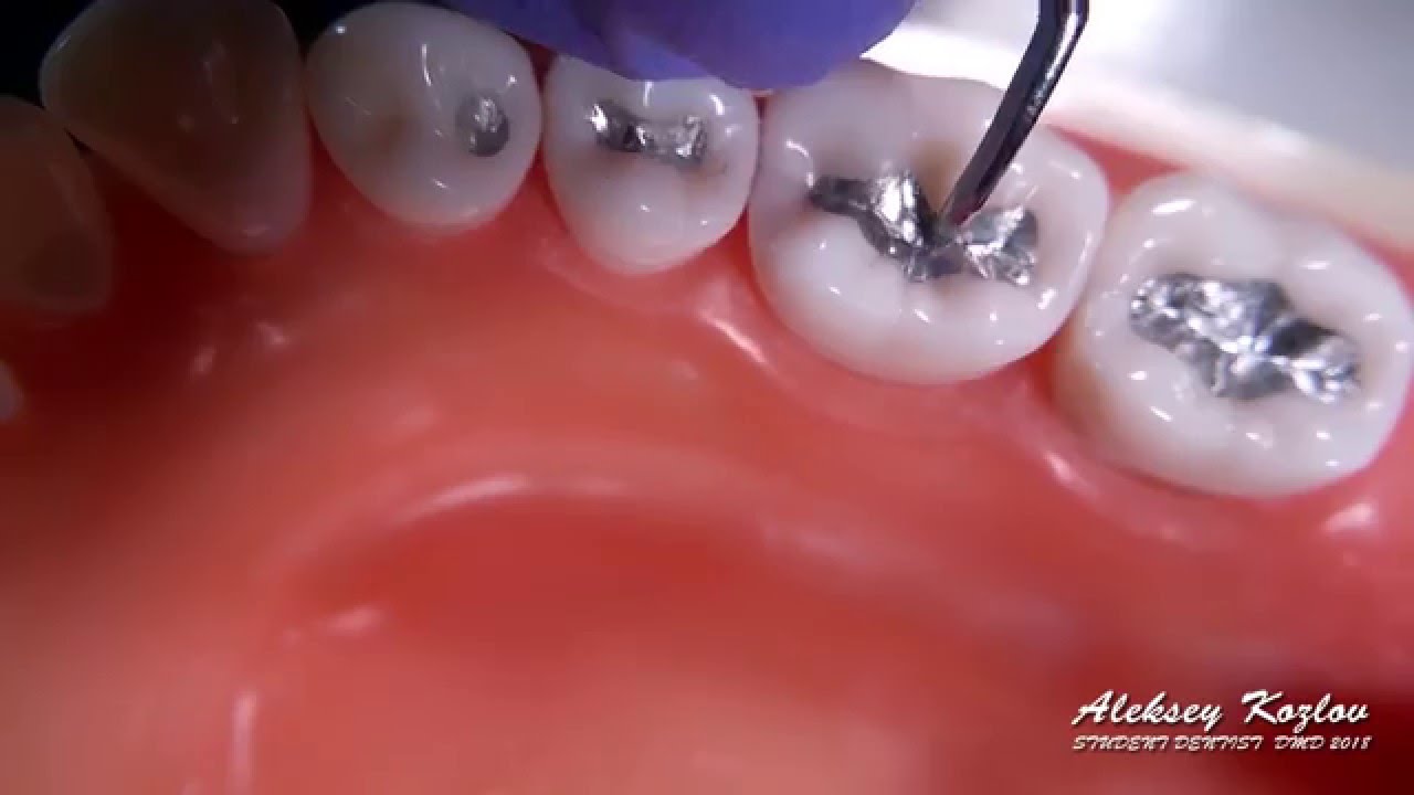 Carving my first Class I Dental Amalgam Restoration (ASMR ...