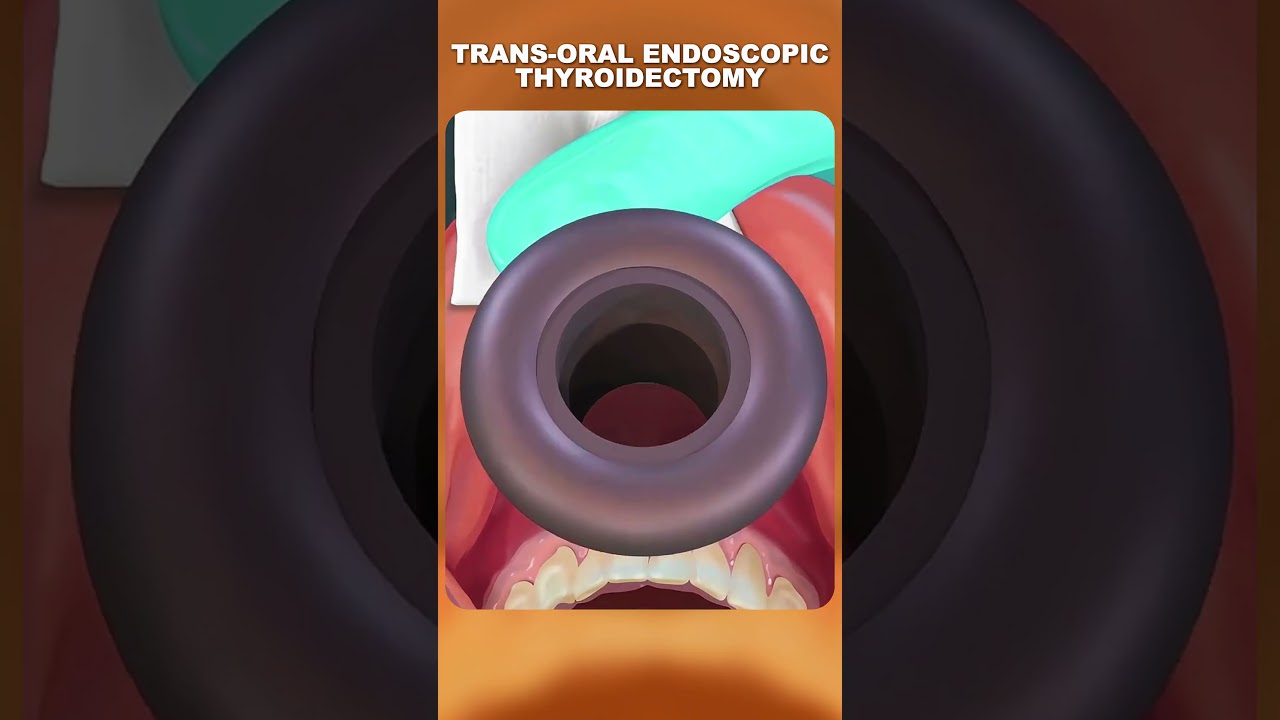 Операция на щитовидной железе без шрама на шее?! 😮