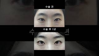 극한눈 3대장 중 첫째 안륜근 손상 +두줄따기  + 겹주름 풀기 #극한눈 #토안 #두줄따기 #겹주름