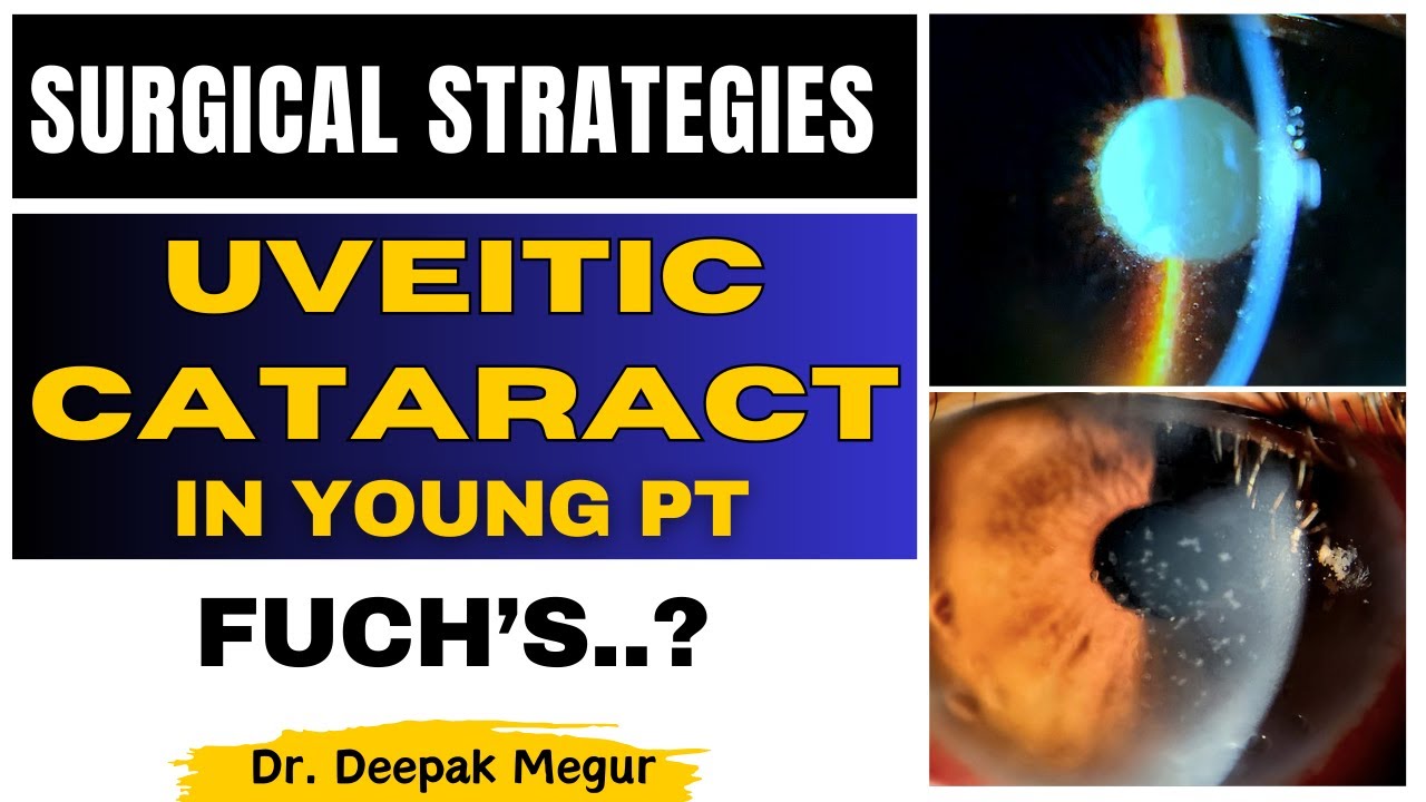 Uveitic Cataract in Young Patient, Surgical strategies Dr. Deepak