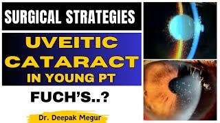 Uveitic Cataract In Young Patient Surgical Strategies - Dr Deepak Megur