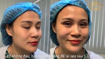 Cắt mí Mini Deep - DR.ANH PHẠM