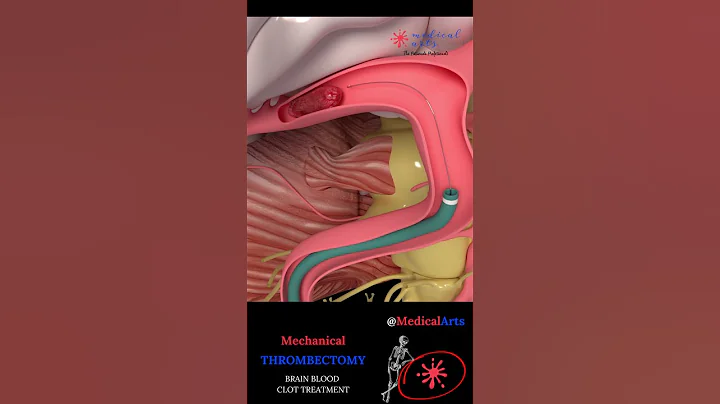 Mechanical Thrombectomy Stroke Animation #ischemicstroke - DayDayNews
